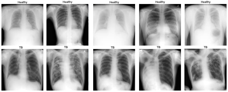 Detecting Tuberculosis in X-Rays